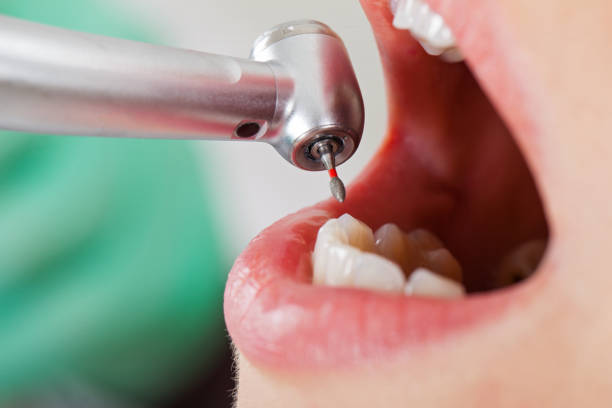 Best Emergency Wisdom Teeth Removal in Birngham, MI